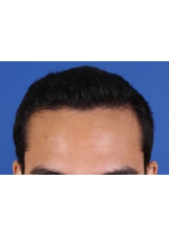 After Hair Transplant&nbsp;Front